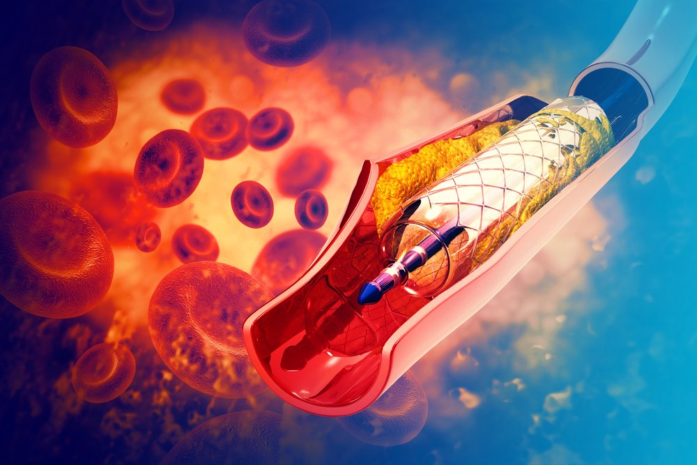 Emis Health Minimally Invasive Vascular Specialists Dallas Texas Arlington interventional care